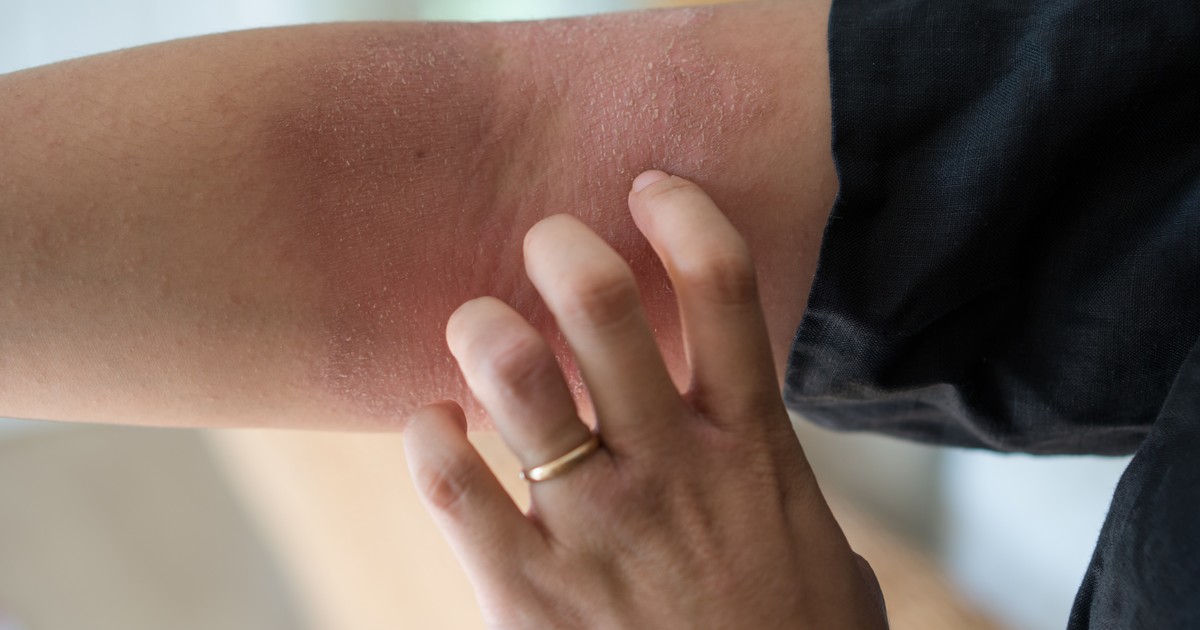 La dermatitis atópica infantil requiere tratamiento temprano para prevenir asma y alergias respiratorias