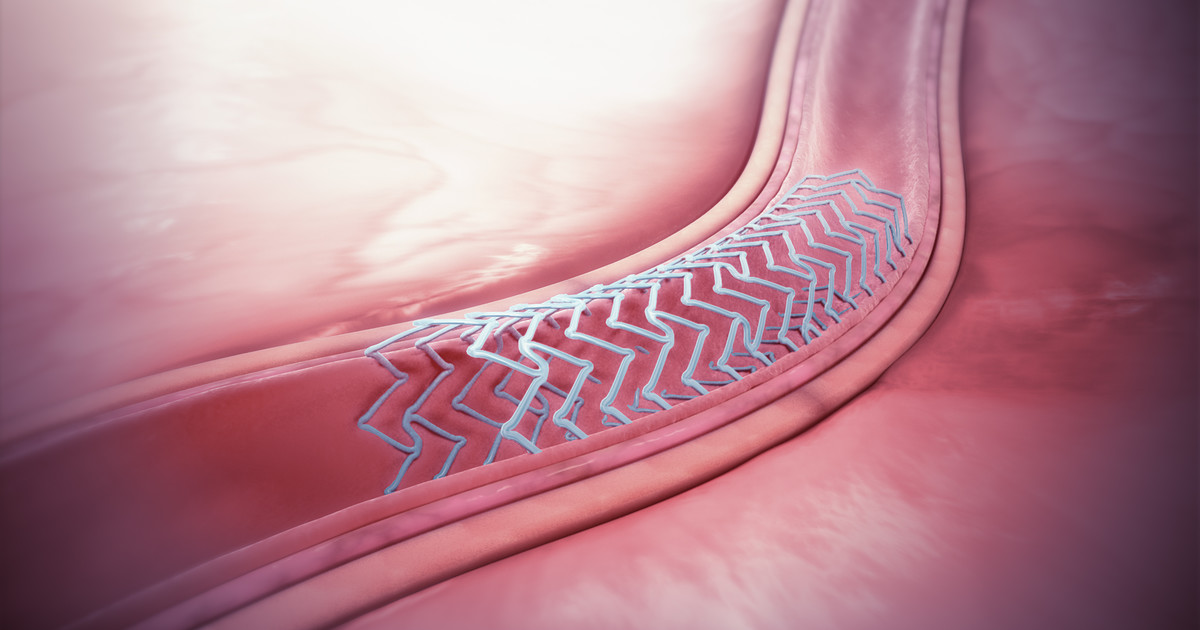 Stents biodegradables: avance en pediatría, pero con límites en adultos